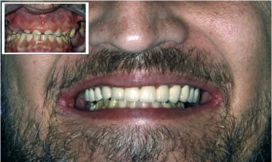 Før tannbehandling (bildet innfelt) og etter behandling. Bildene er gjengitt med tillatelse fra pasienten. Foto: Tannlege Jørn Aas.